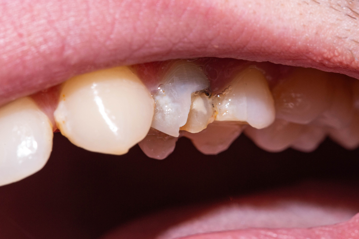 Close-up of chipped front tooth showing damage and dental restoration needs in Bixby.
