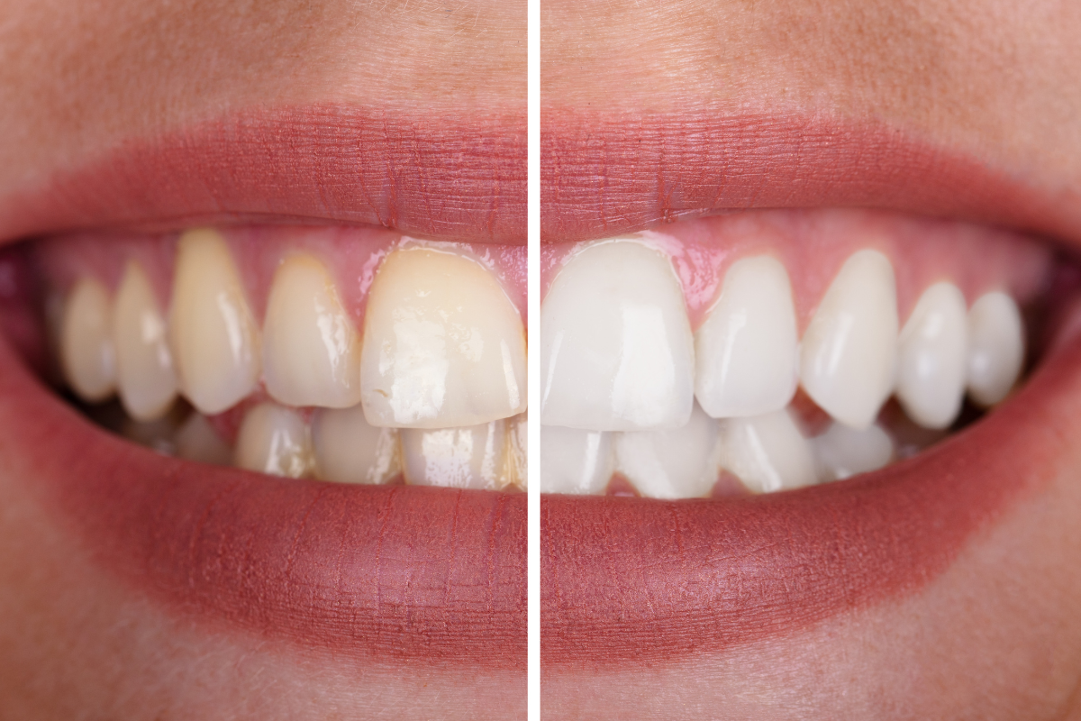 Before and after teeth whitening comparison showing yellowed teeth transformed to bright white teeth.