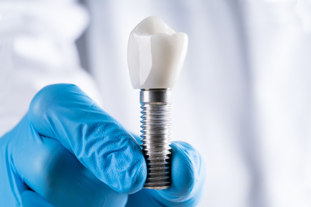 Dental implant with titanium screw held by gloved hand showing prosthetic tooth component.