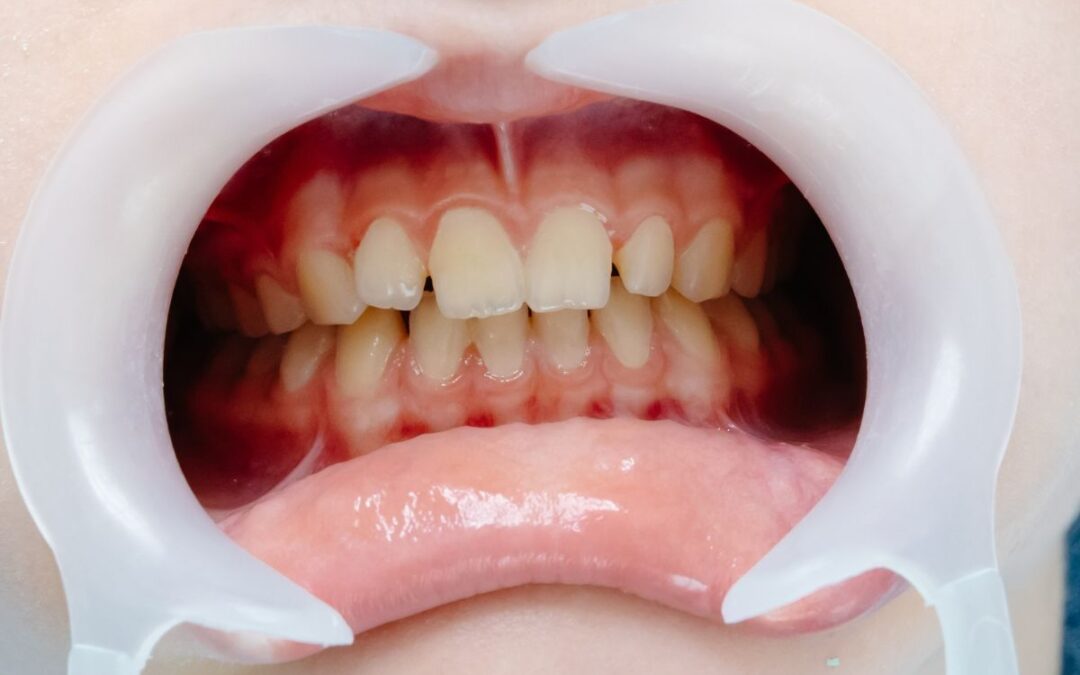 Can Invisalign Fix Overbites?