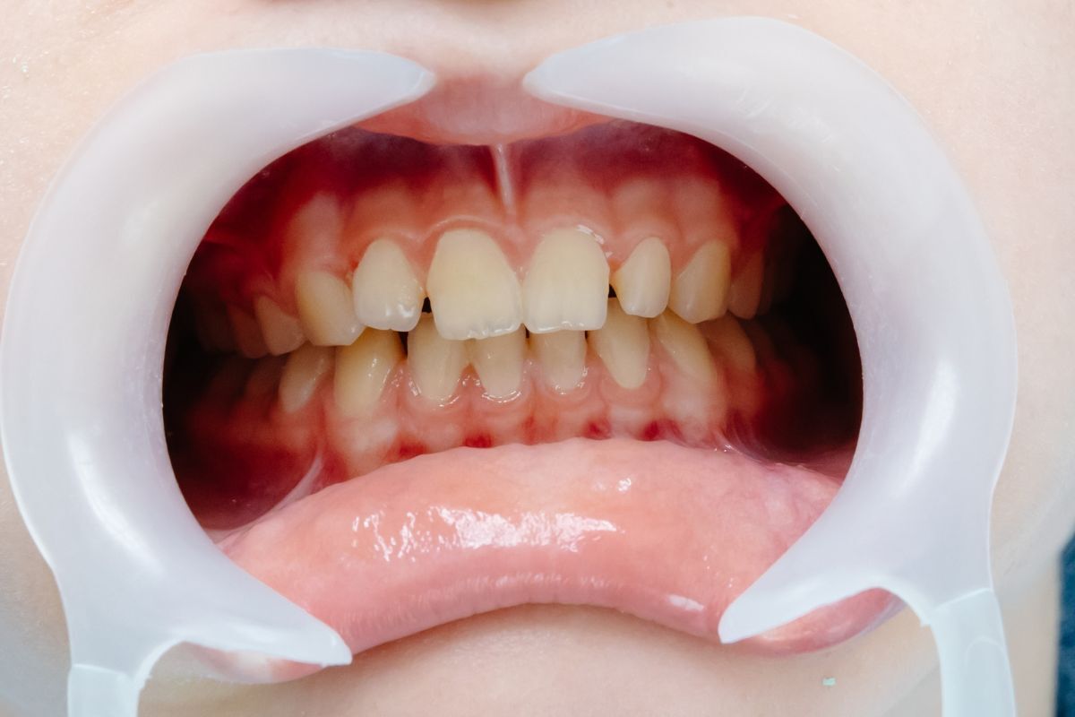 Close-up of patient's open mouth showing upper teeth with slight overbite and inflamed gums during dental examination.