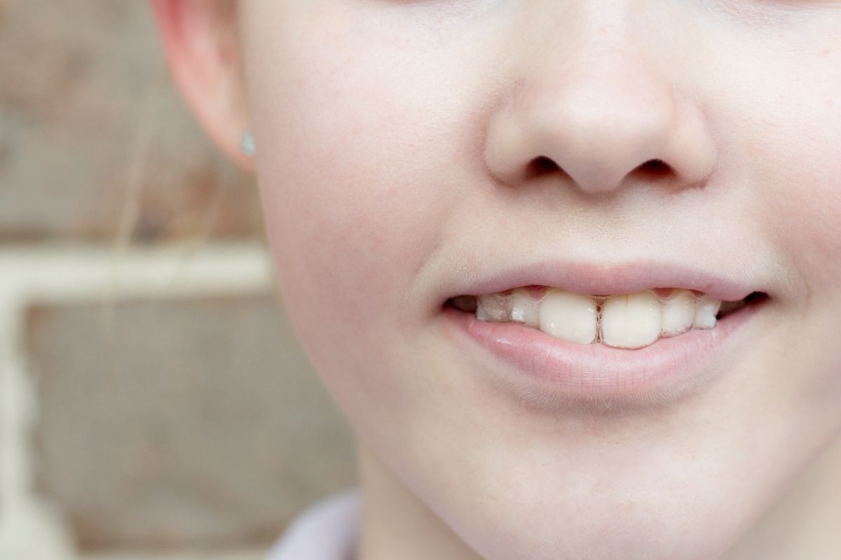 Young patient displaying improved smile after Invisalign treatment for underbite correction in Bixby.