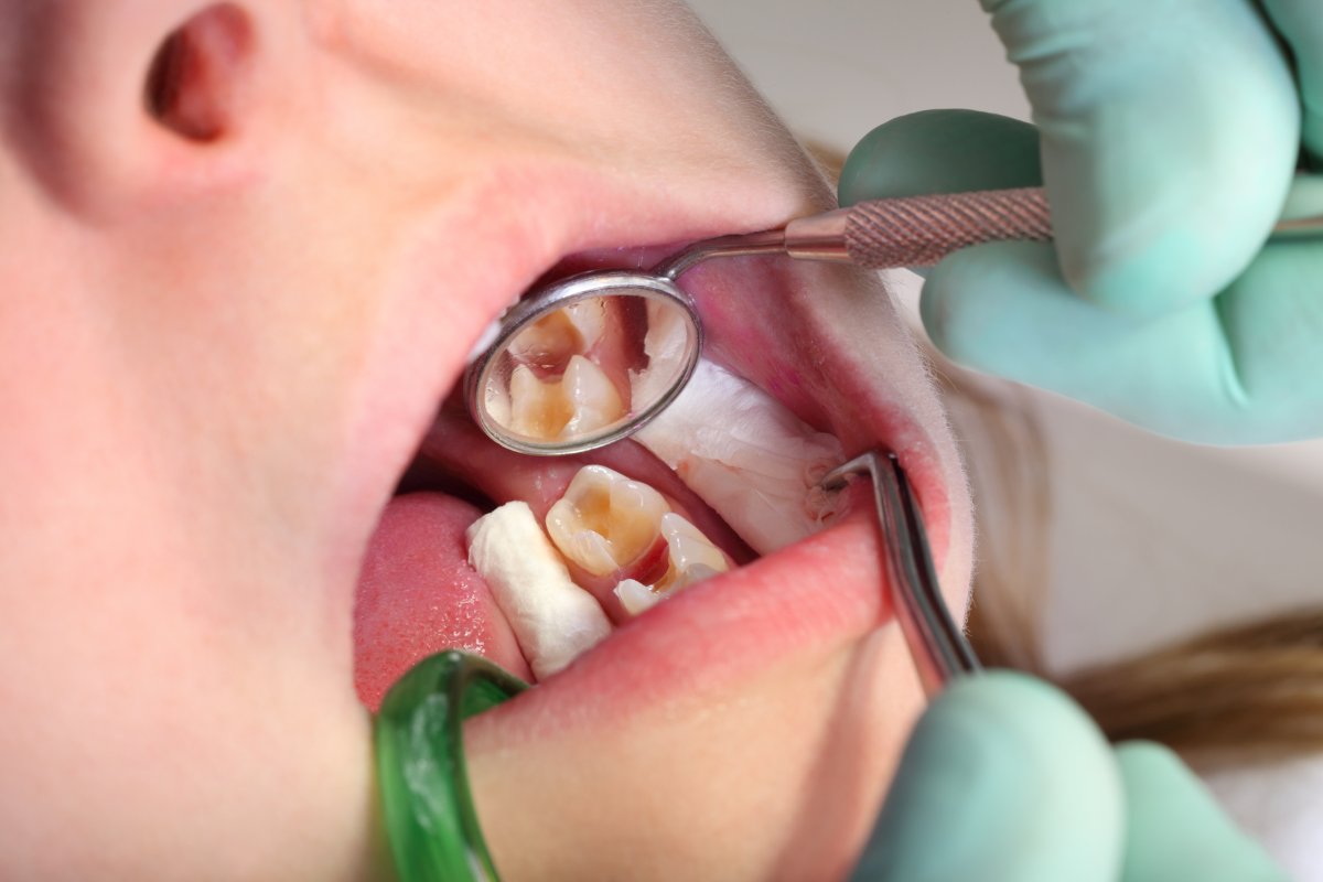 Dentist examining patient's teeth with decay during dental filling consultation and treatment.
