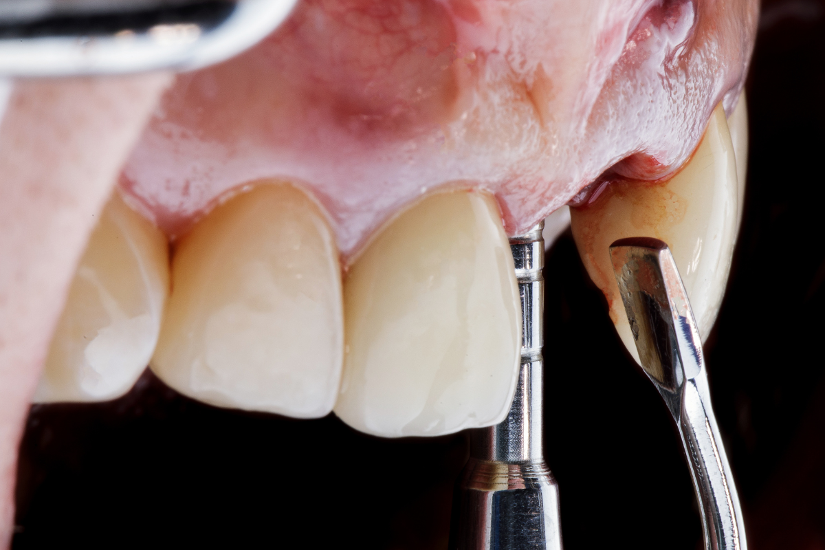 Dental bone graft procedure showing tooth implant site preparation with surgical instruments in Bixby.