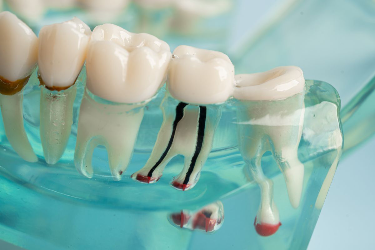 Dental model showing tooth anatomy with root canals and pulp tissue highlighted in red.