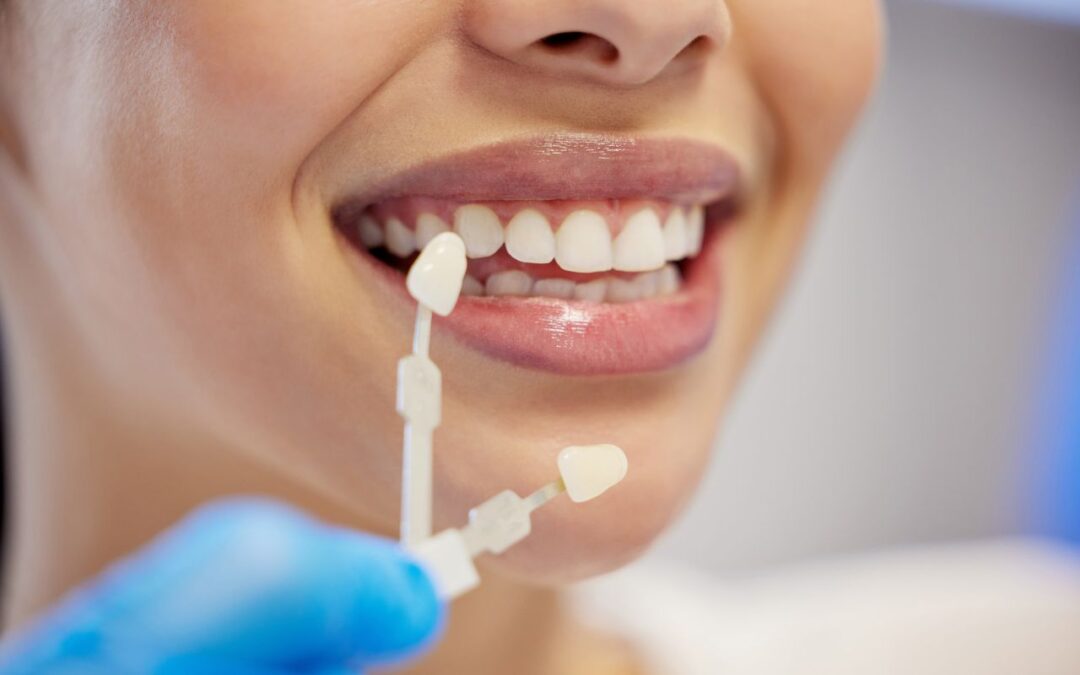Can Veneers Be Whitened? What Bixby, OK, Patients Should Know