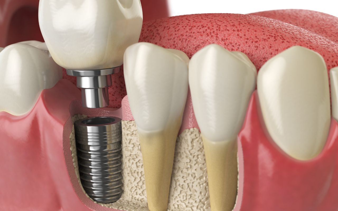 Dental implant illustration showing titanium post in jawbone alongside natural teeth in Bixby.