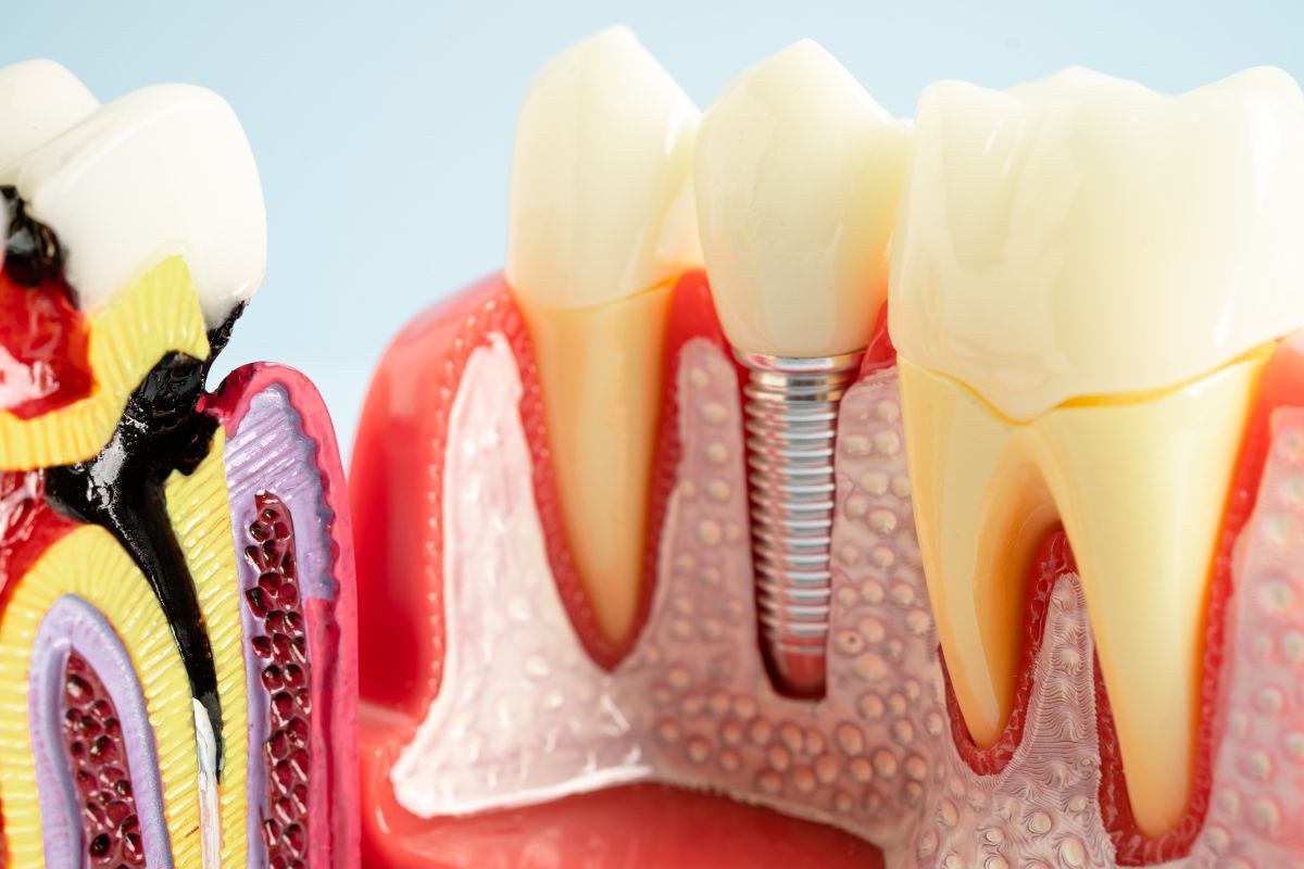 3D dental implant diagram showing tooth crown, metal screw, and gum tissue structure.