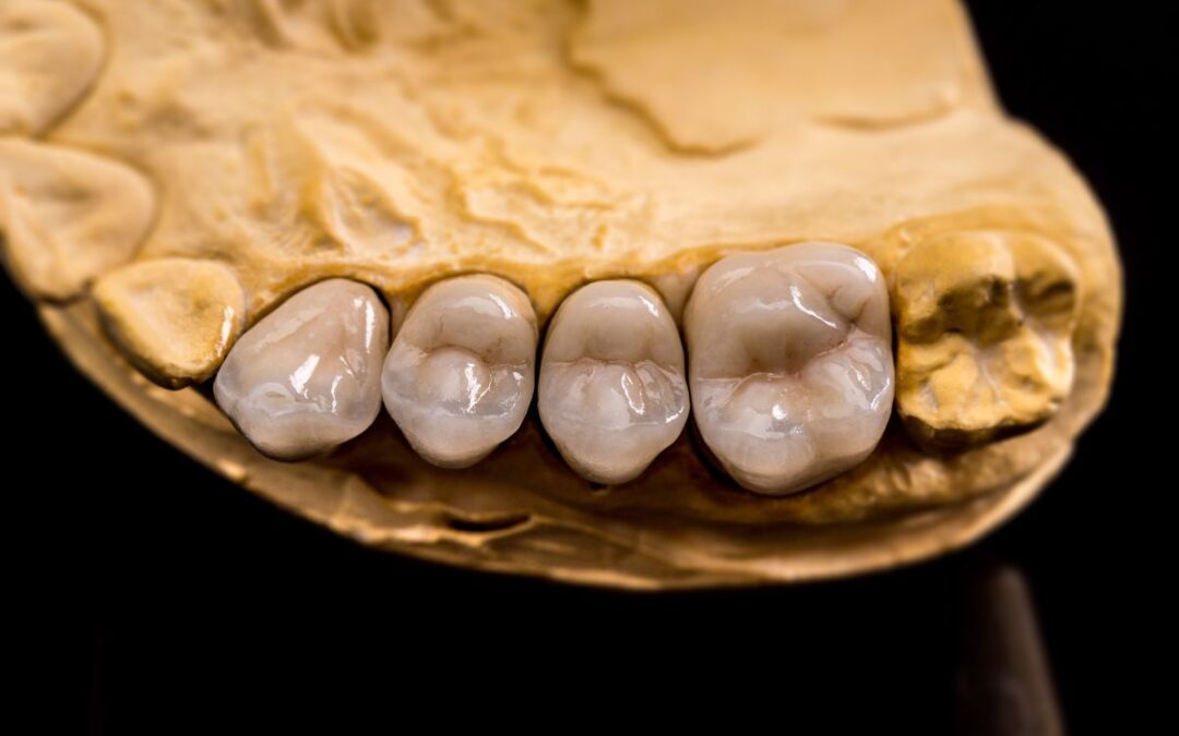 Do Teeth Go Bad Under Crowns?