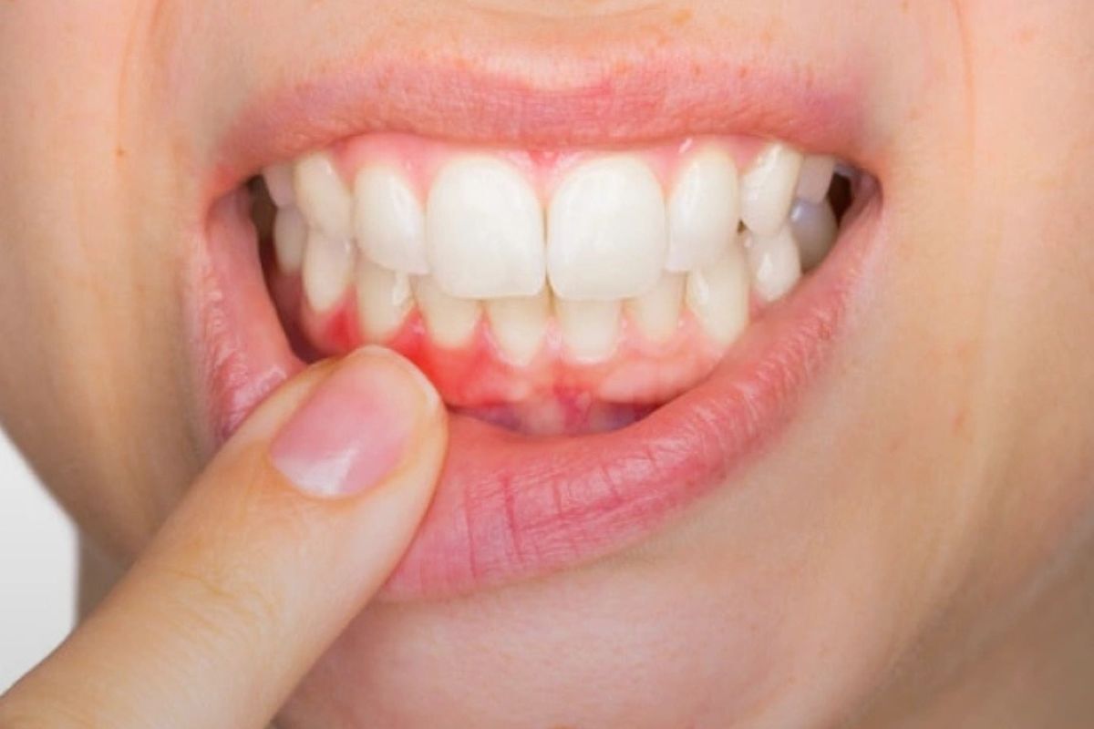 Person pointing to inflamed gum tissue showing signs of tooth infection and gum disease.