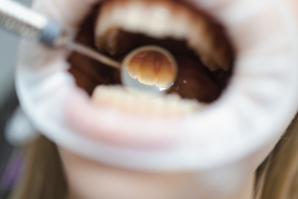 Close-up of a tooth with a small cavity or decay spot during dental examination.