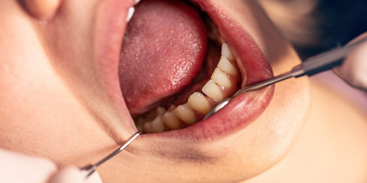 Close-up of dental examination showing discolored tooth being inspected with mirror.