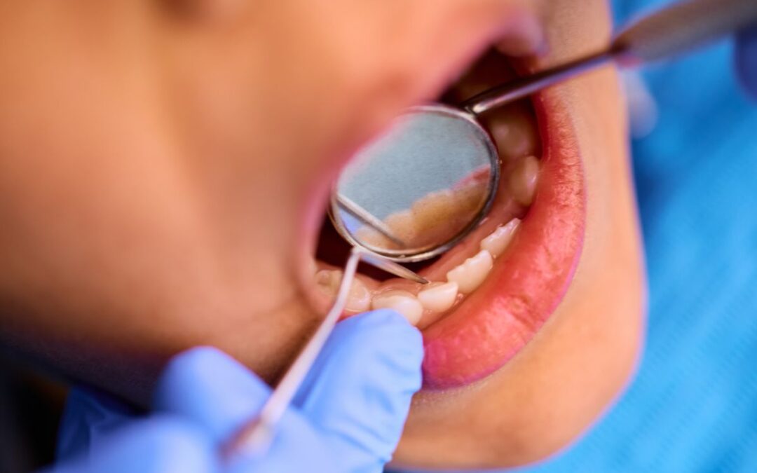 Why Your Fillings Keep Failing And How Dentists Fix the Root Cause