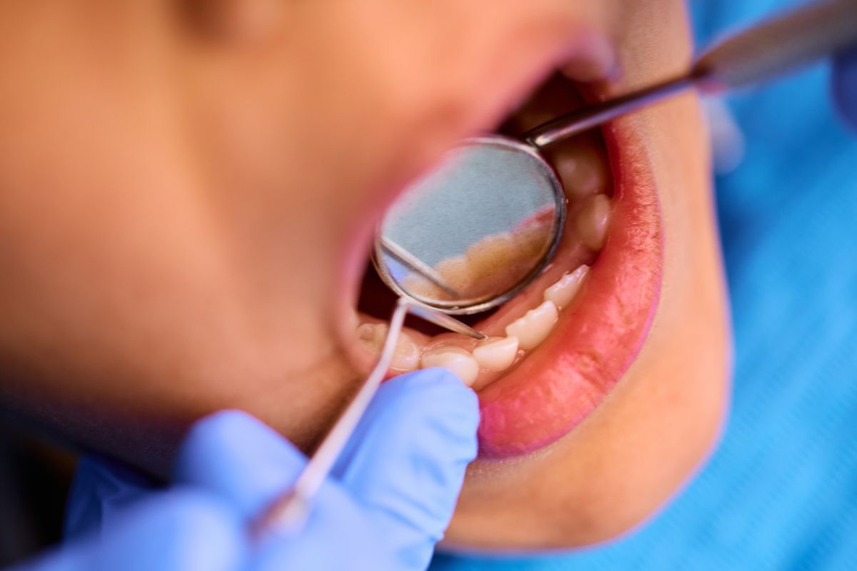 Dentist examining tooth with mirror during dental filling inspection and repair.
