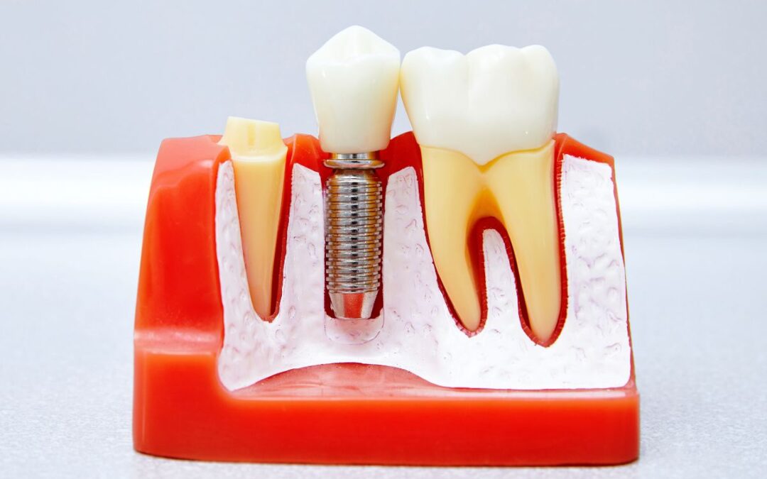 Bone Grafting Before Implants: What Patients Should Know