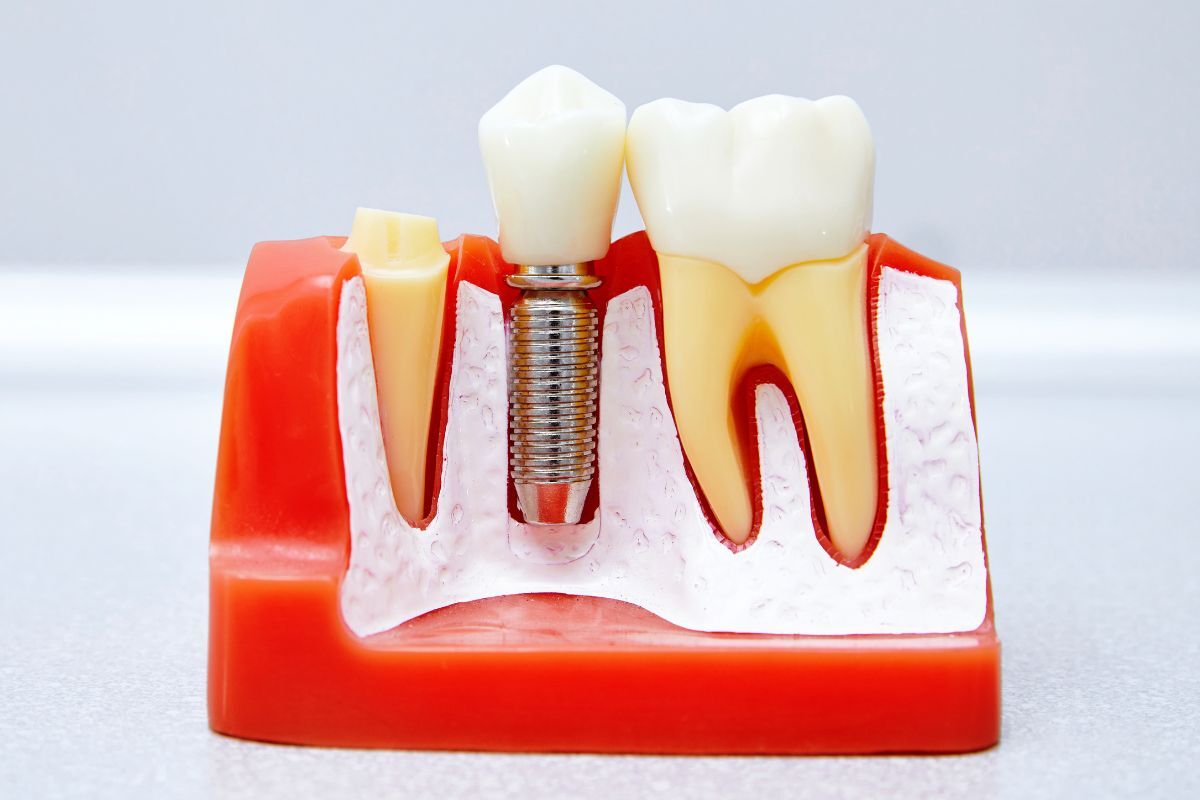 Bone Grafting Before Implants Dental implant model showing bone graft placement between natural teeth and titanium implant fixture.