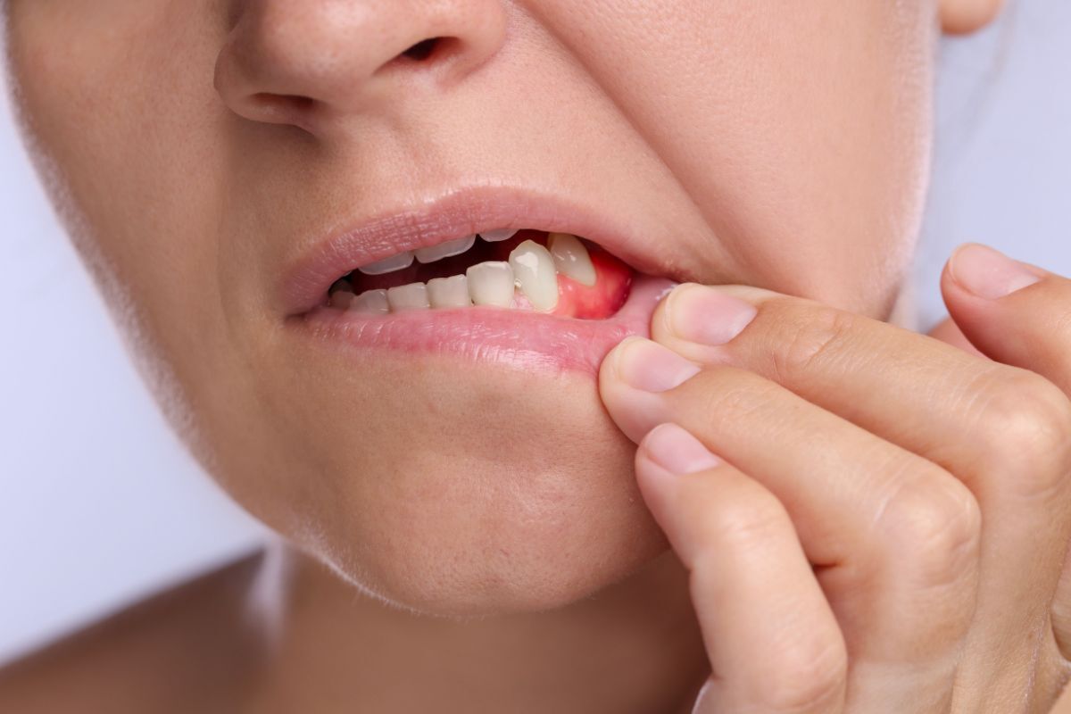 Child pointing to inflamed gum tissue showing signs of gum disease and infection.