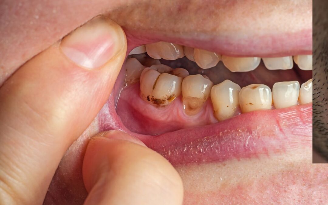 Signs of a Cavity You Shouldn’t Ignore