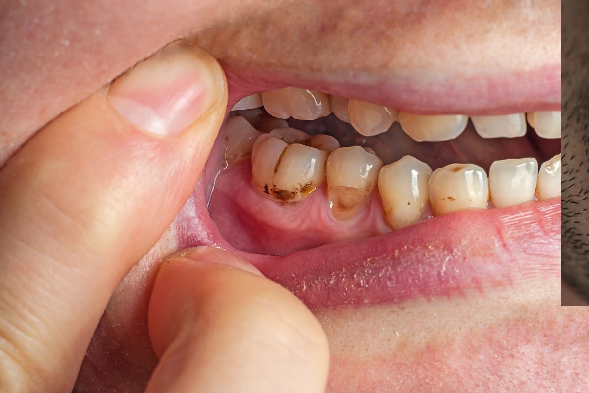 Close-up of tooth decay showing brown discoloration and cavities requiring dental treatment.