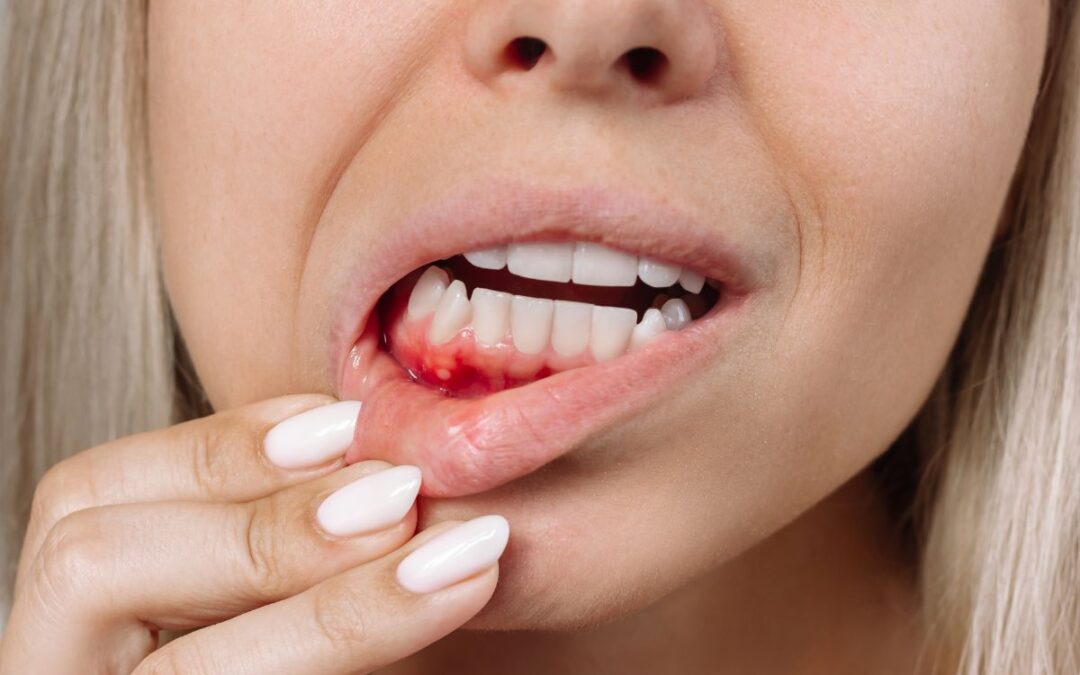 What Is Gum Disease and How Is It Treated?