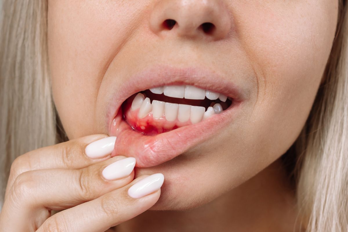 Woman showing inflamed gum tissue with redness and swelling indicating gum disease.