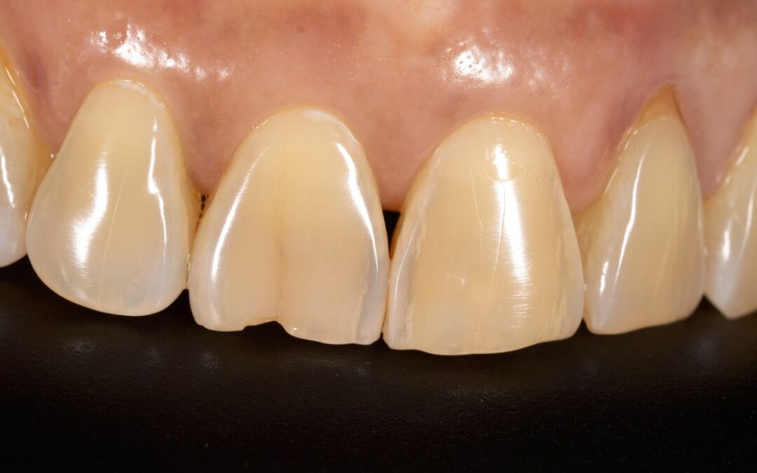 What to Do If You Crack a Tooth