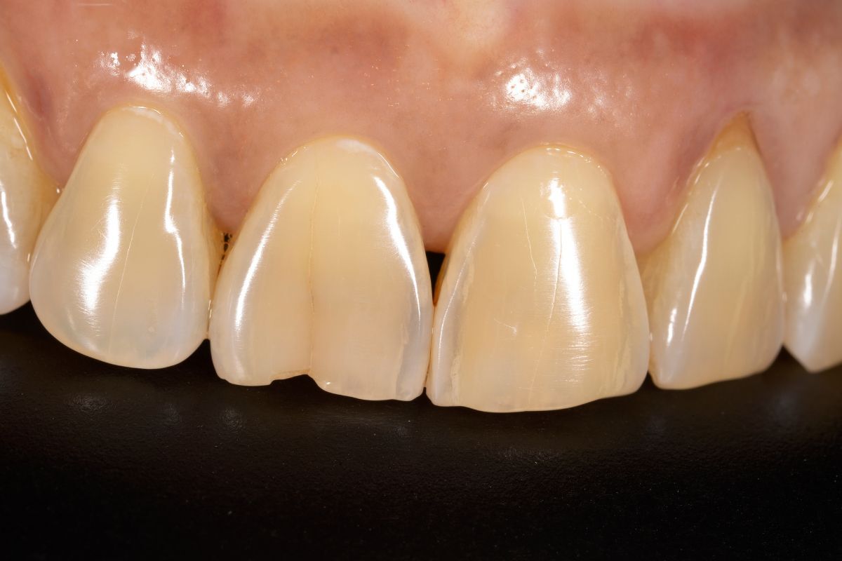 Ceramic dental crowns showing natural tooth color and shine on upper front teeth.