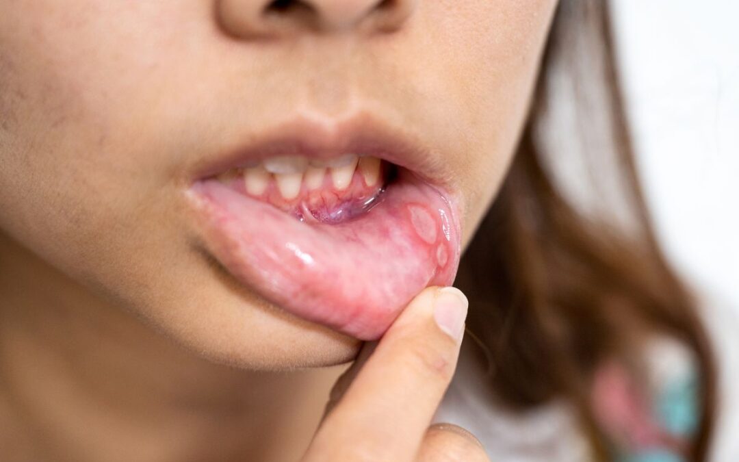 What Causes Recurring Mouth Sores and When They’re a Concern