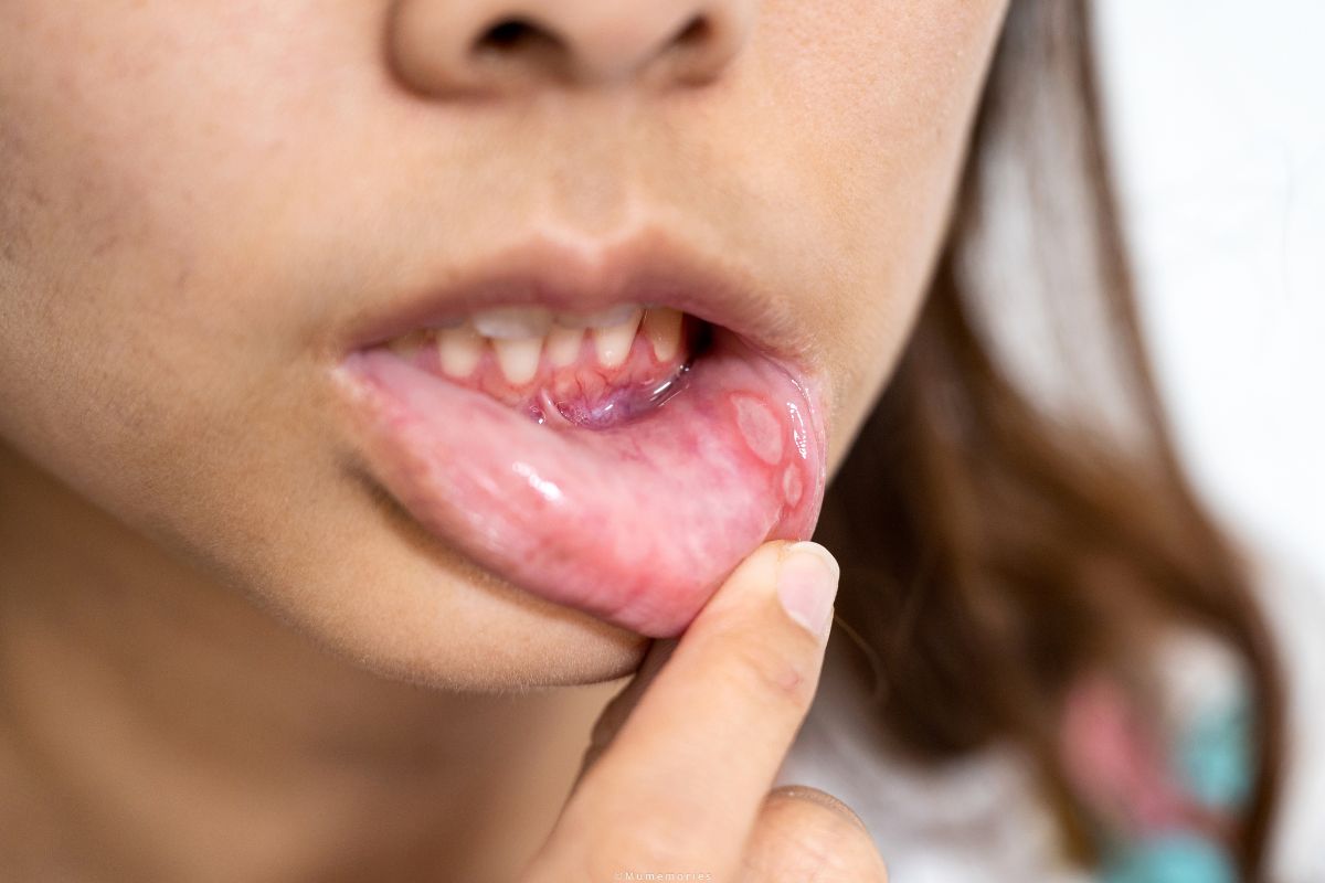 recurring mouth sores when to worry recurring mouth sores when to worry