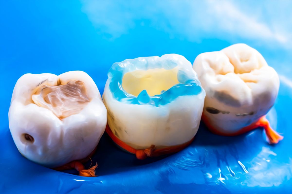 Worn Filling Replacement Signs Worn filling replacement signs that may indicate a filling needs dental evaluation