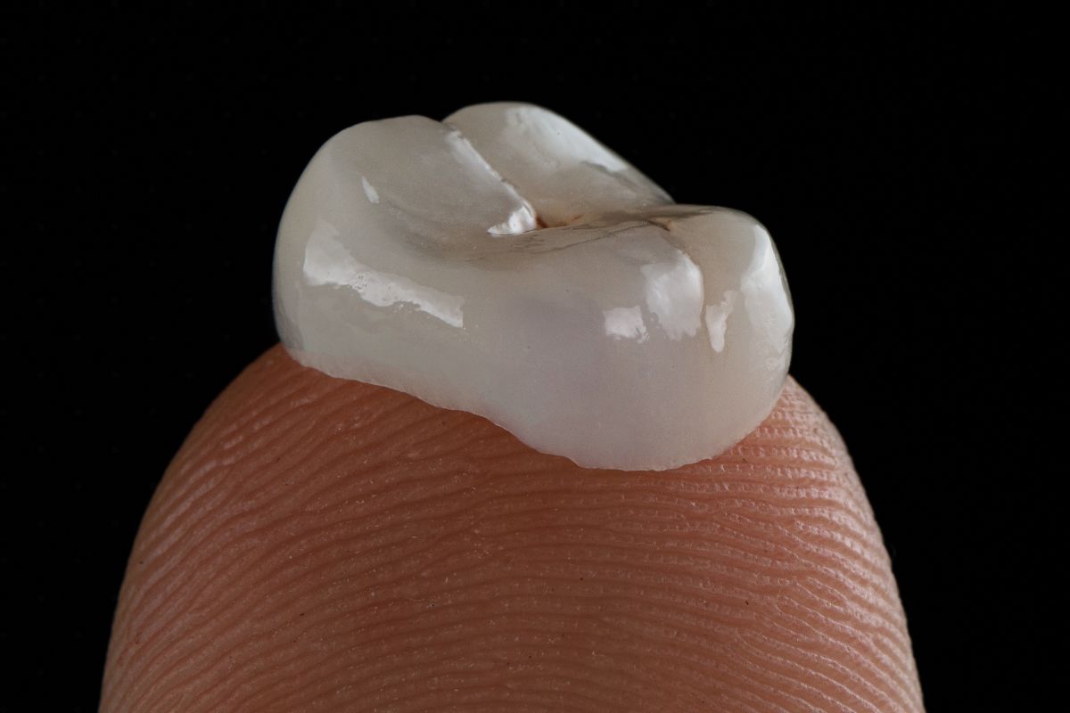 Dental Crown Fell Out: What to Do Next Dental crown that has fallen out and needs professional evaluation in Bixby